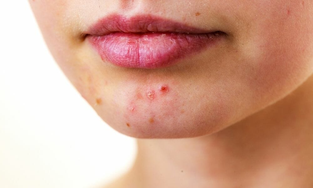 chinen salt benefits for acne